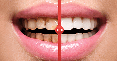 before_after